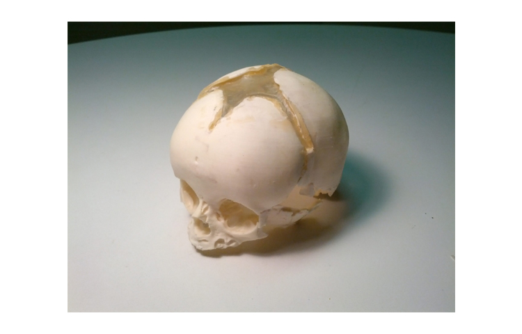 加拿大Truephantom新生兒頭骨模體